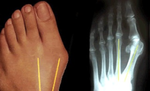 Bunion